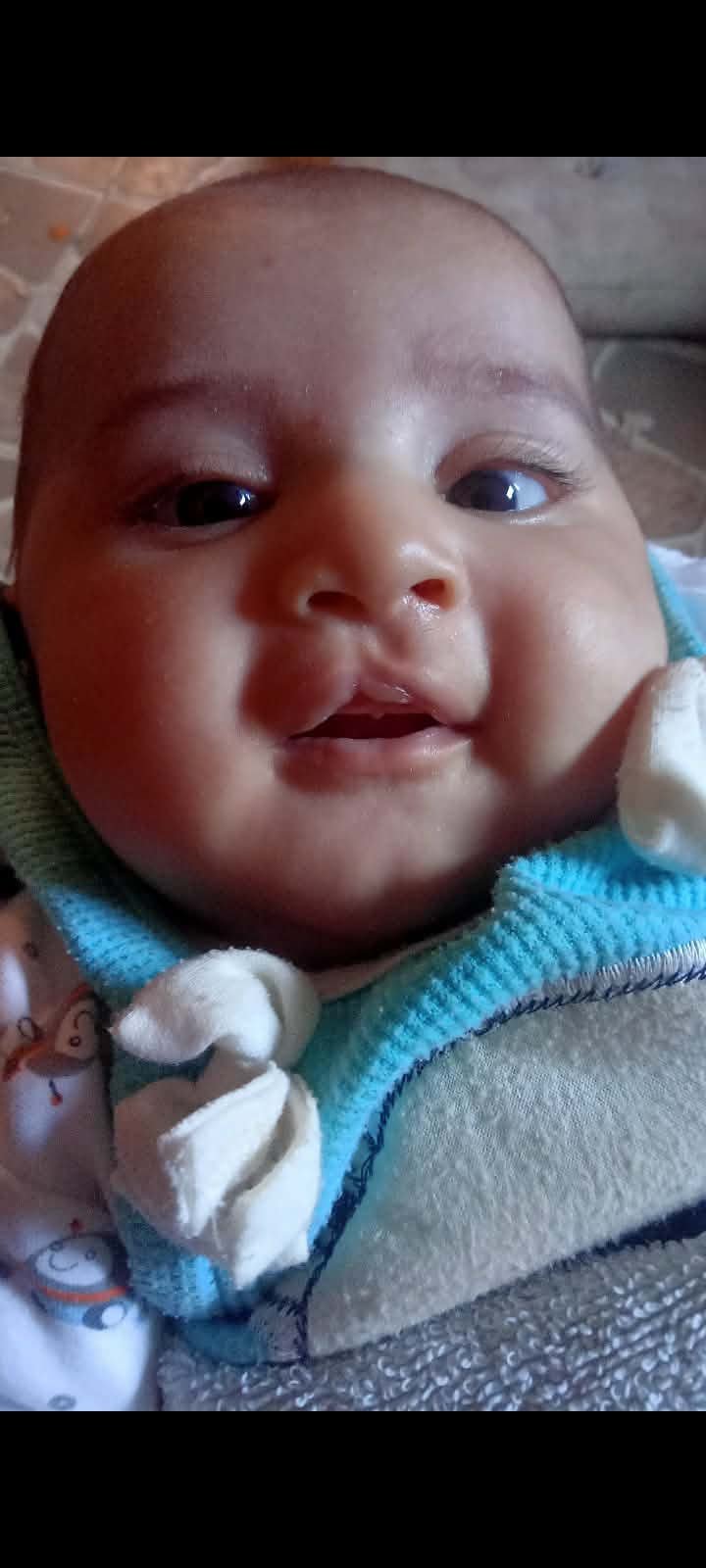 Maryam cleft lip repair case before surgery - view 1