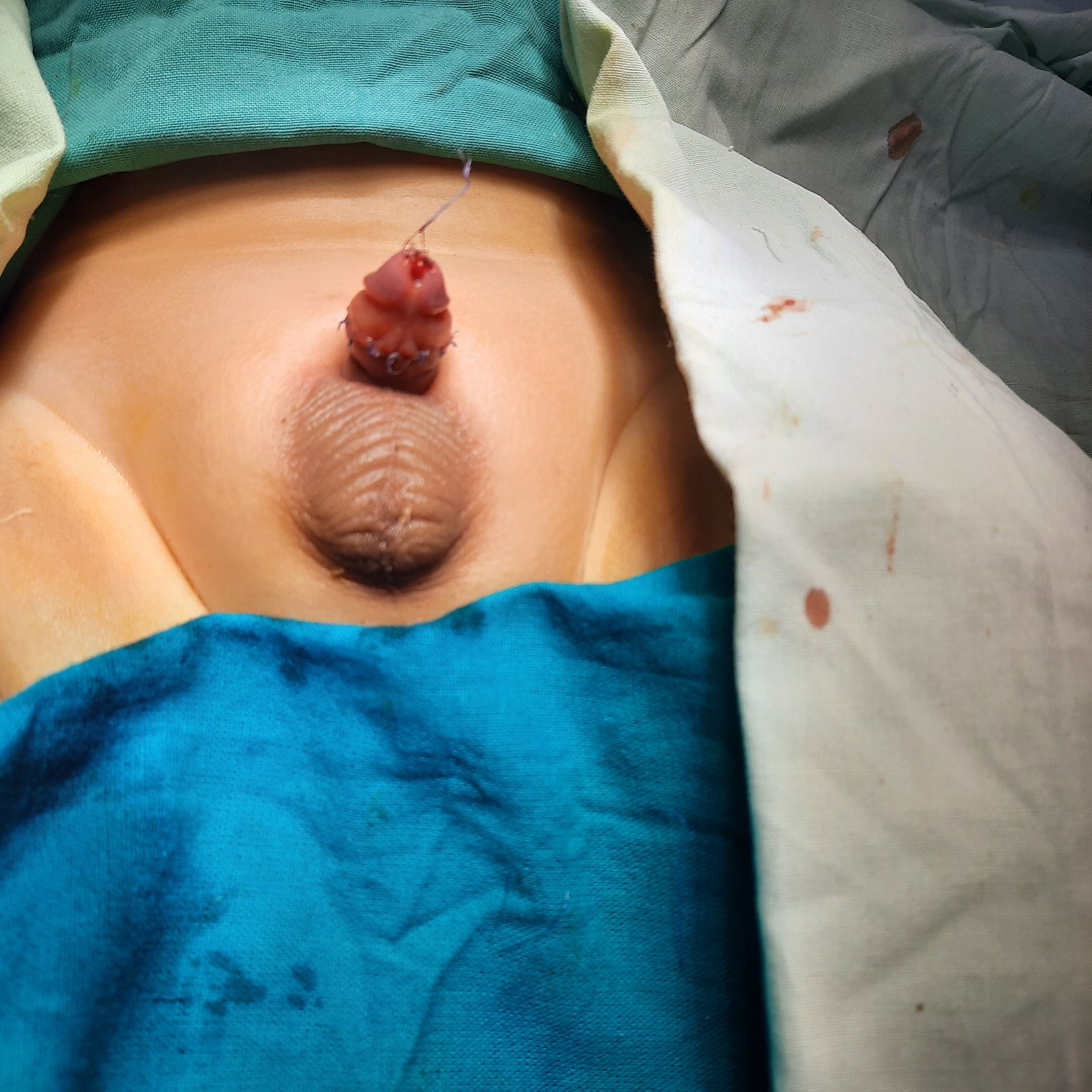 Penile release and exposure to natural length postoperative result - view 1