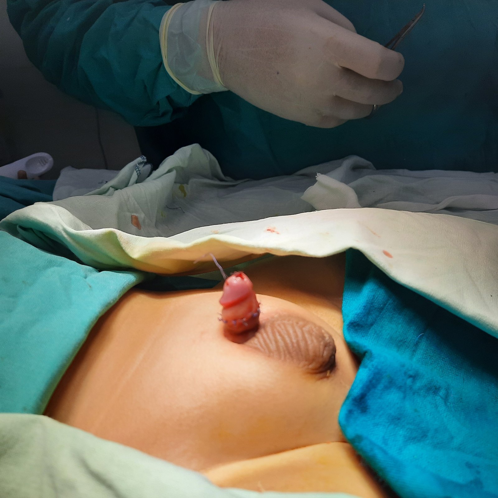 Penile release and exposure to natural length postoperative result - view 2