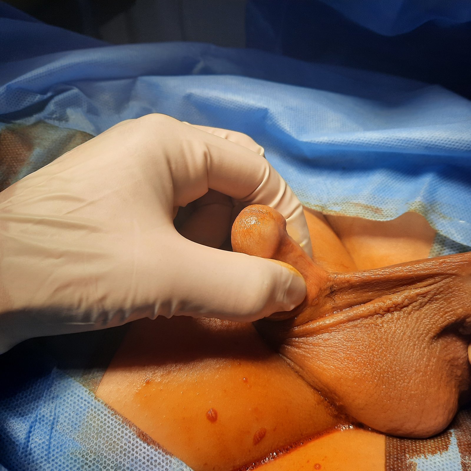 Penile skin deficiency and penoscrotal adhesion before revision surgery - view 1
