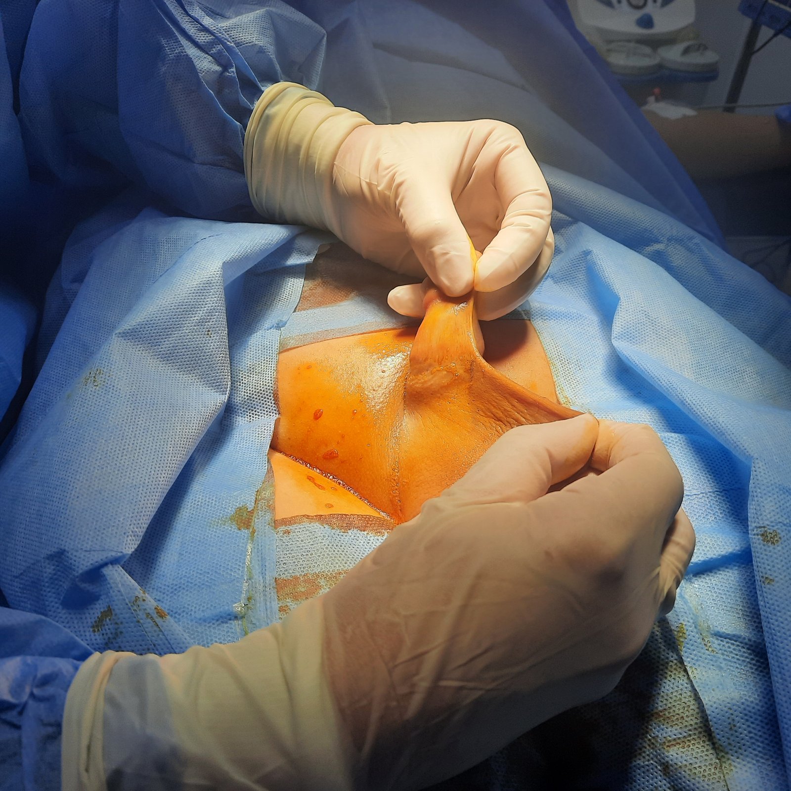 Penile skin deficiency and penoscrotal adhesion before revision surgery - view 2